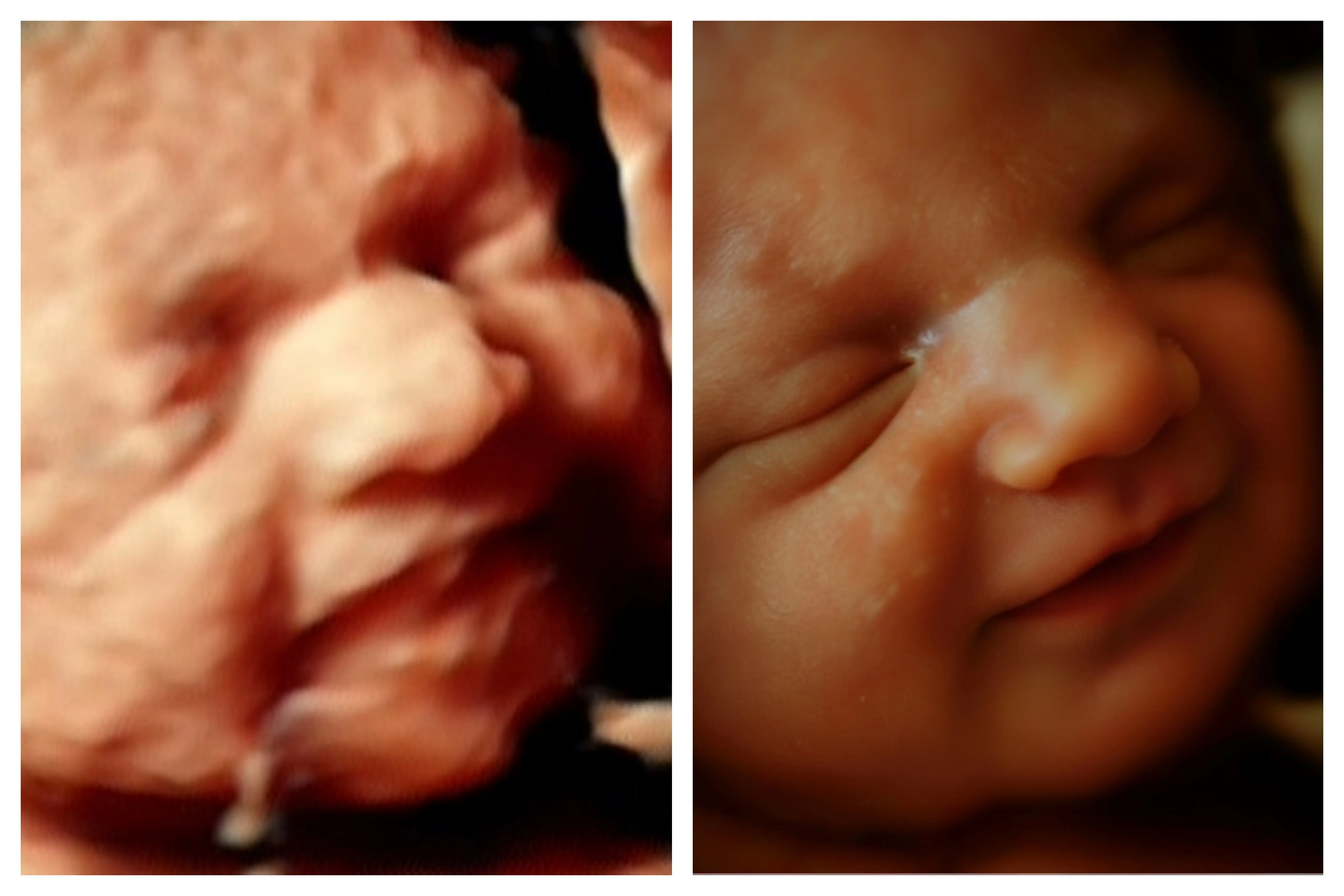 Ecografía 8K HD procesada con IA - Econatal Galicia Baleares