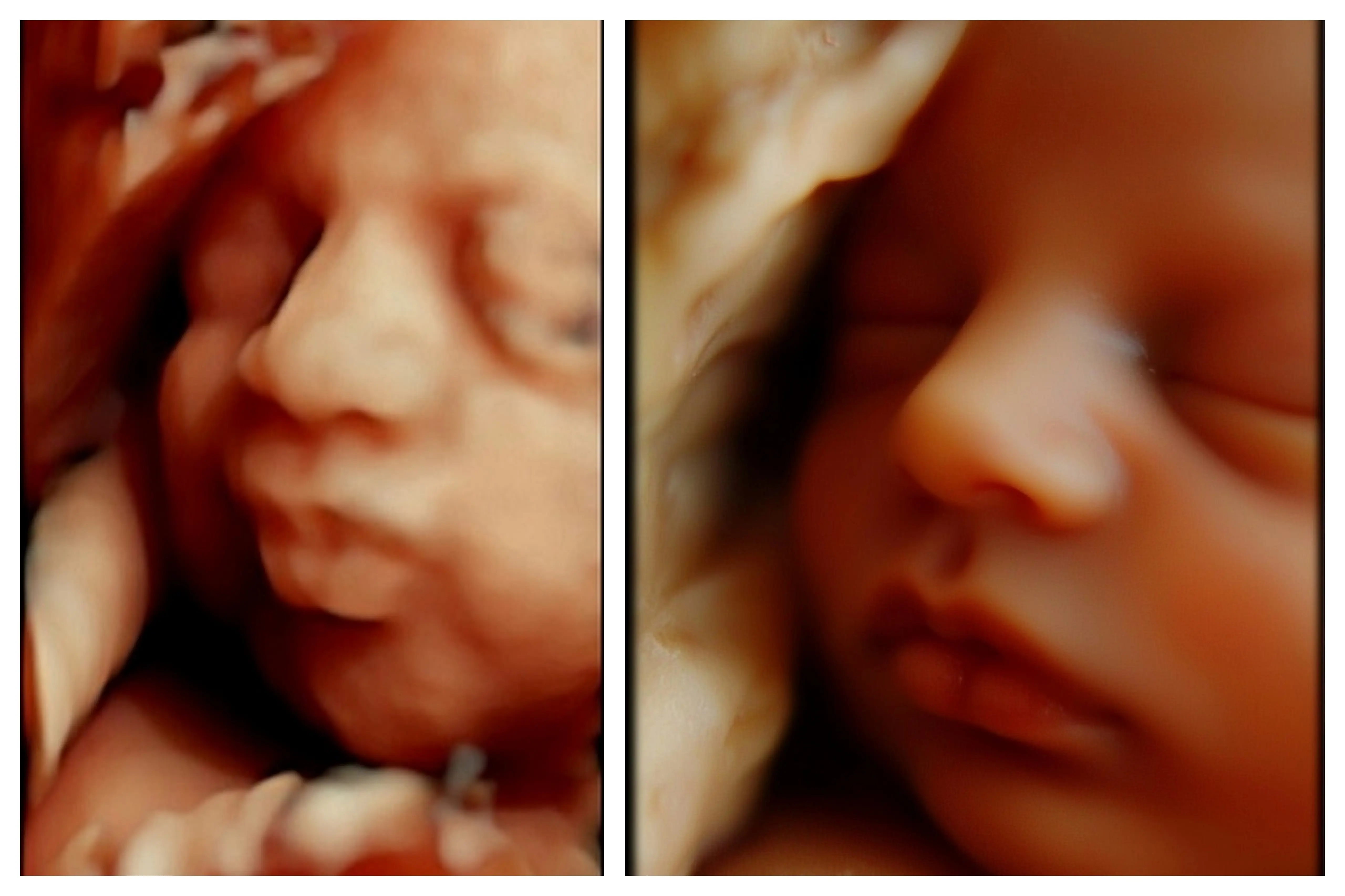 Ecografía 8K HD procesada con IA - Econatal Galicia Baleares