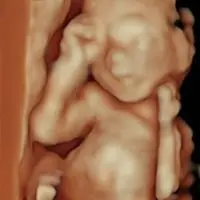 Carita bebé realista ecografía 5D - Econatal Galicia Baleares