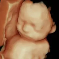 Ecografía 5D emocional resultado real - Econatal Palma de Mallorca