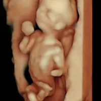 Carita bebé en ecografía 5D - tecnología 8K HD Econatal